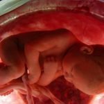 Aborto: Con 6 meses alegó no tenía para comer; Niña nació viva y la médico la asfixió en una funda