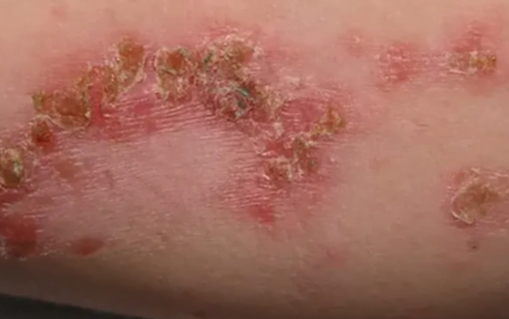 Detectan infección de piel resistente a medicamentos en Nueva York