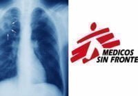 Tuberculosis: Médicos sin Fronteras pide fabricantes de medicamentos reduzcan costo de los tratamientos